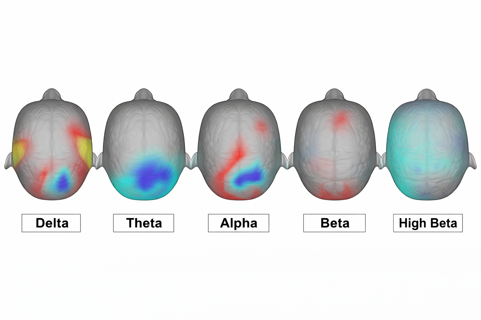 Example qEEG brain map showing Delta, Theta, Alpha, Beta, and High Beta brainwave activity